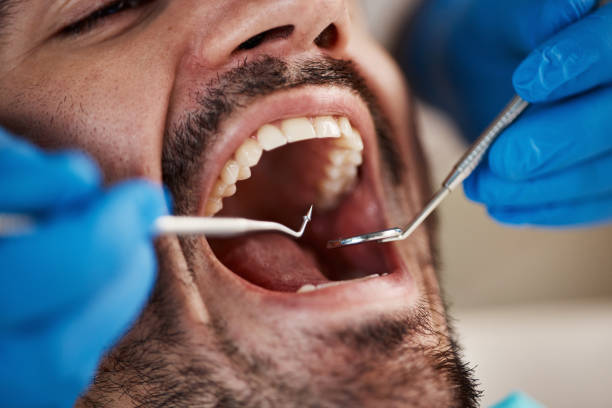 Best Dentist for Tooth Abscess  in Vermilion, OH
