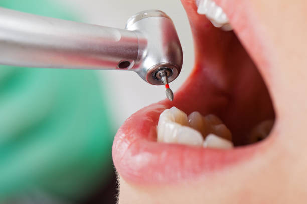 Best Chipped Tooth Repair Near Me  in Vermilion, OH